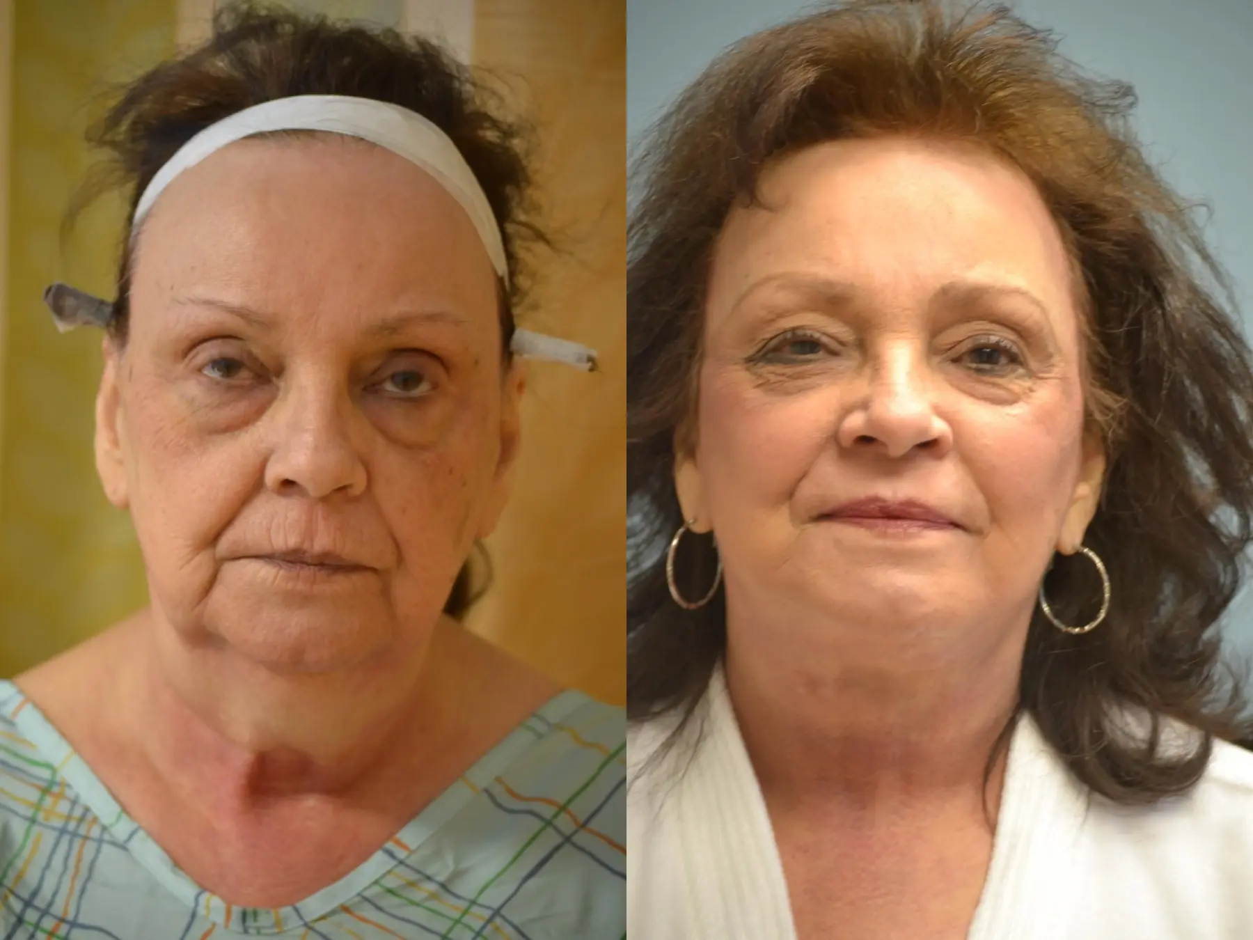 Facelift: Patient 13 - Before and After 1