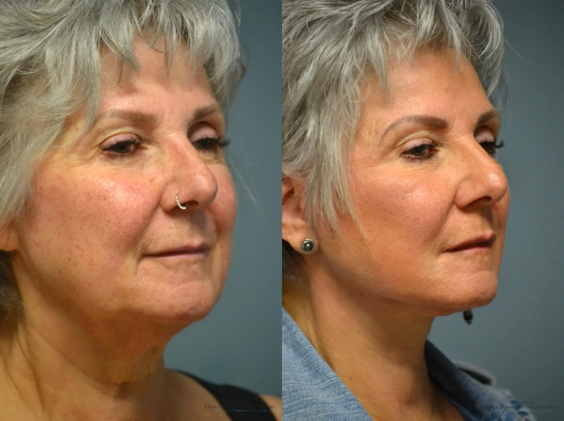 Facelift: Patient 13 - Before and After 4