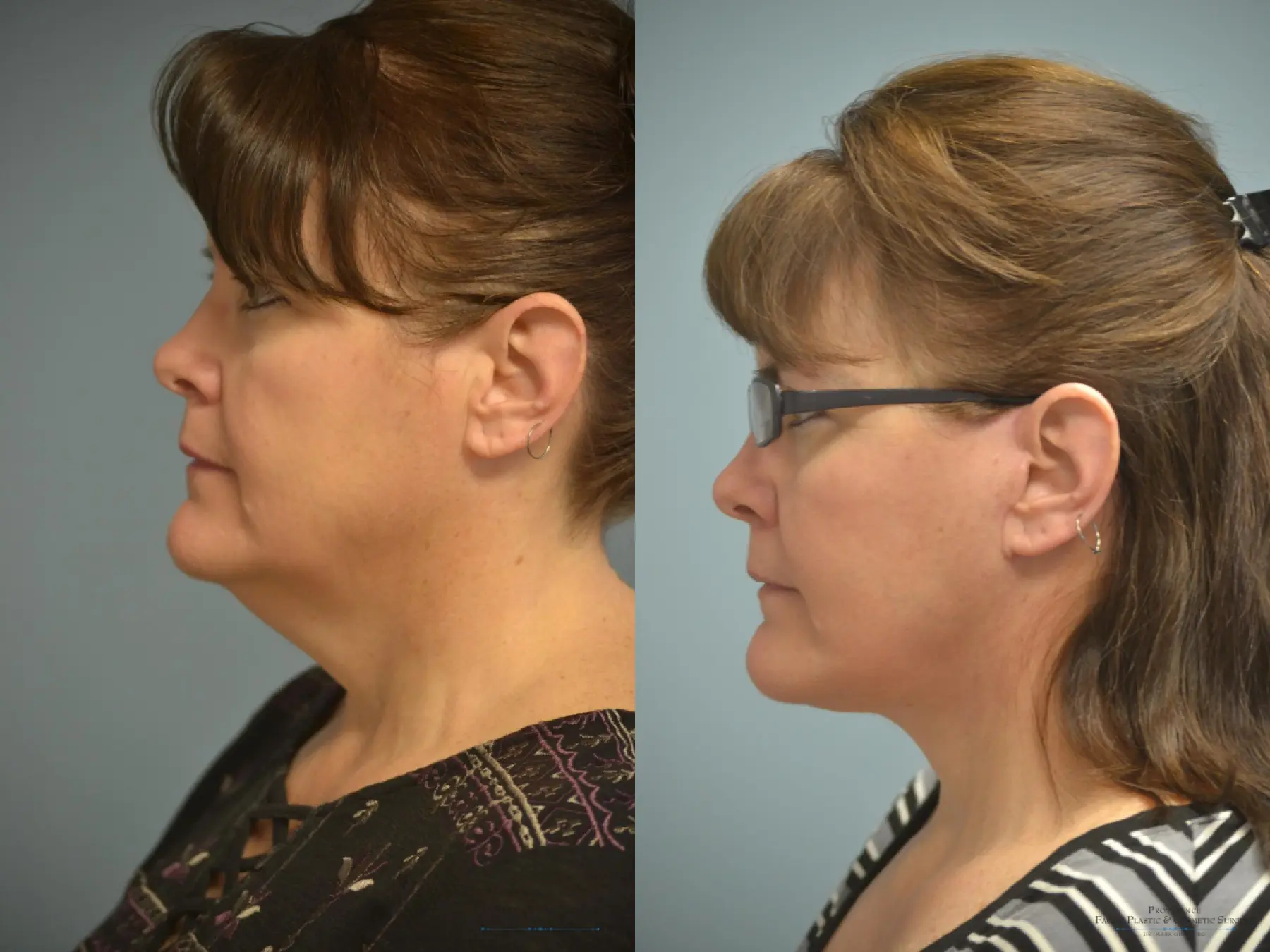 Facelift: Patient 9 - Before and After  