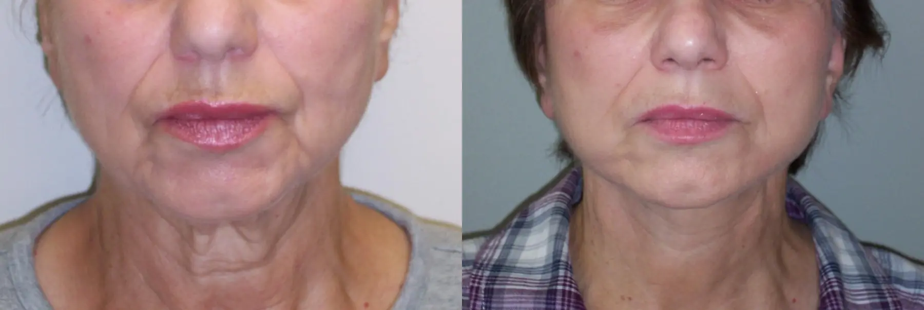 Facelift: Patient 10 - Before and After 2