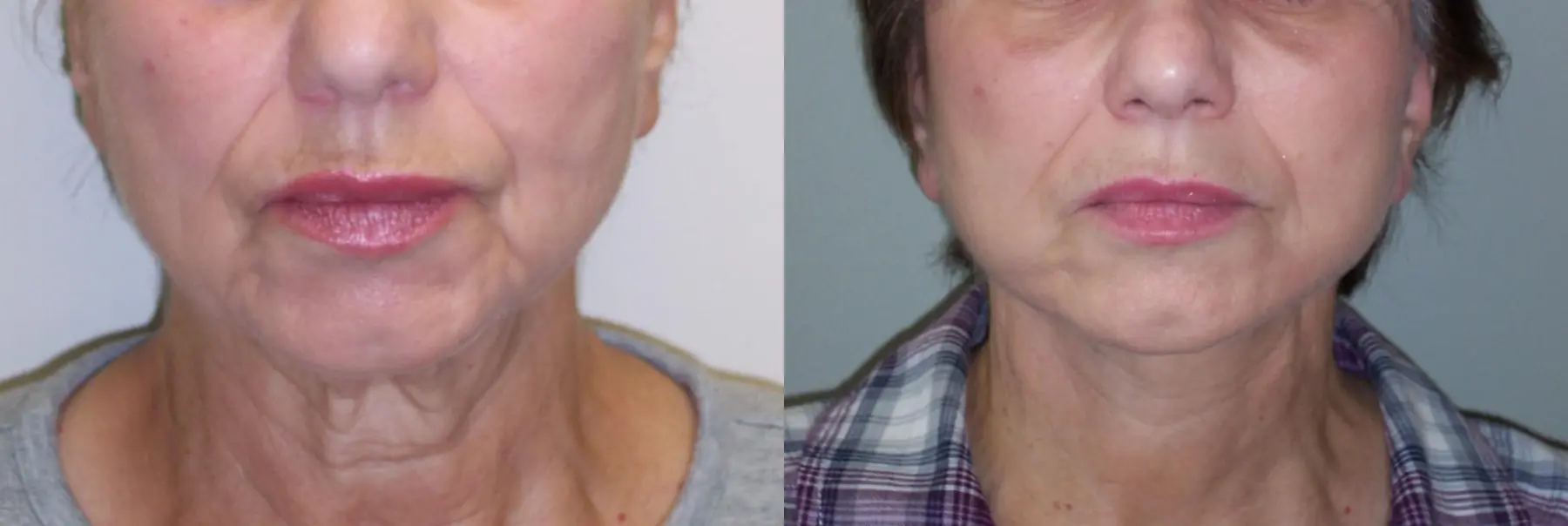 Facelift: Patient 11 - Before and After 2