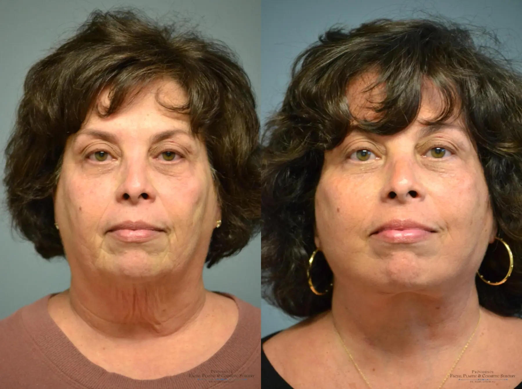 Facelift: Patient 1 - Before and After  