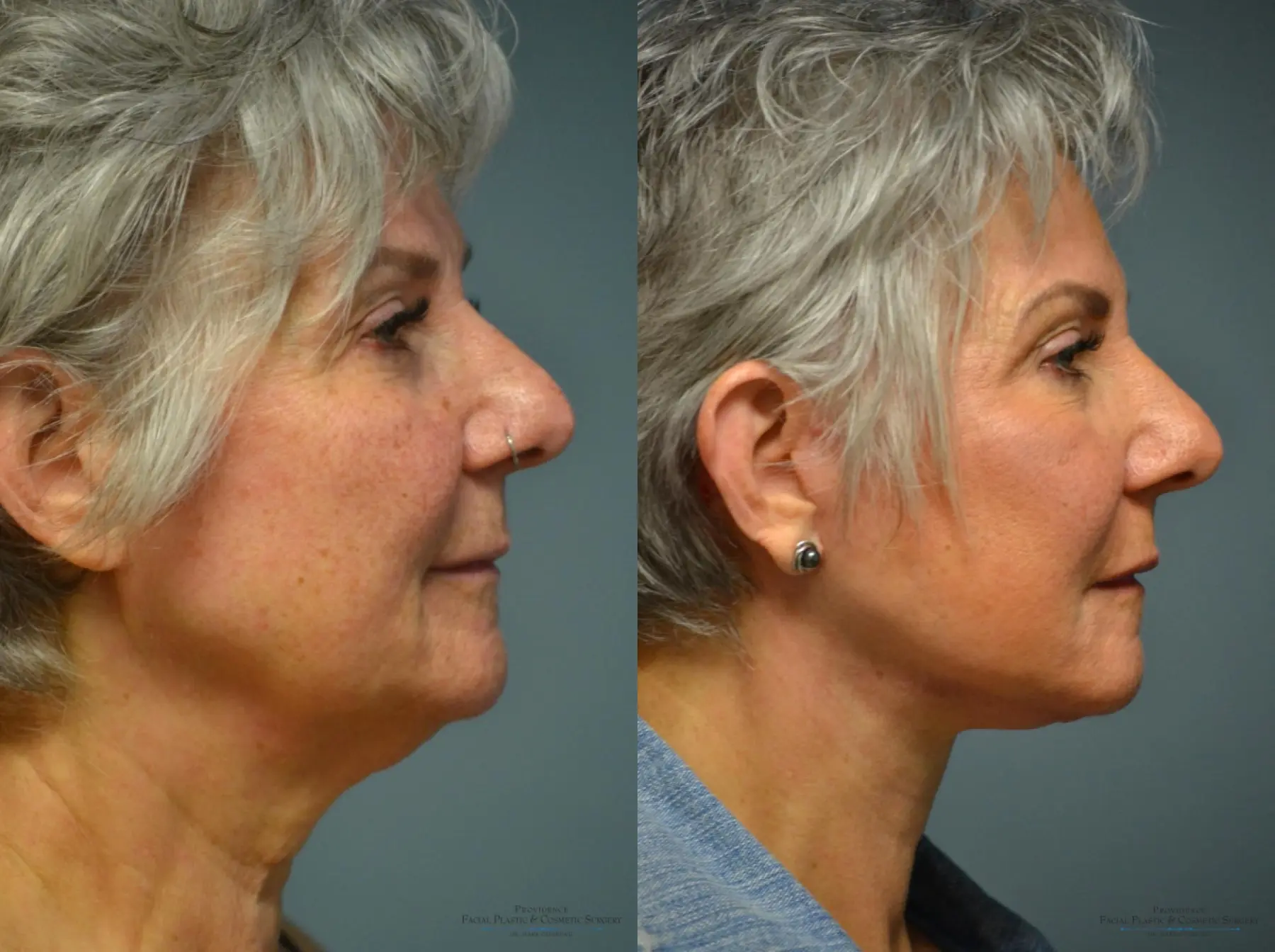 Facelift: Patient 13 - Before and After 5