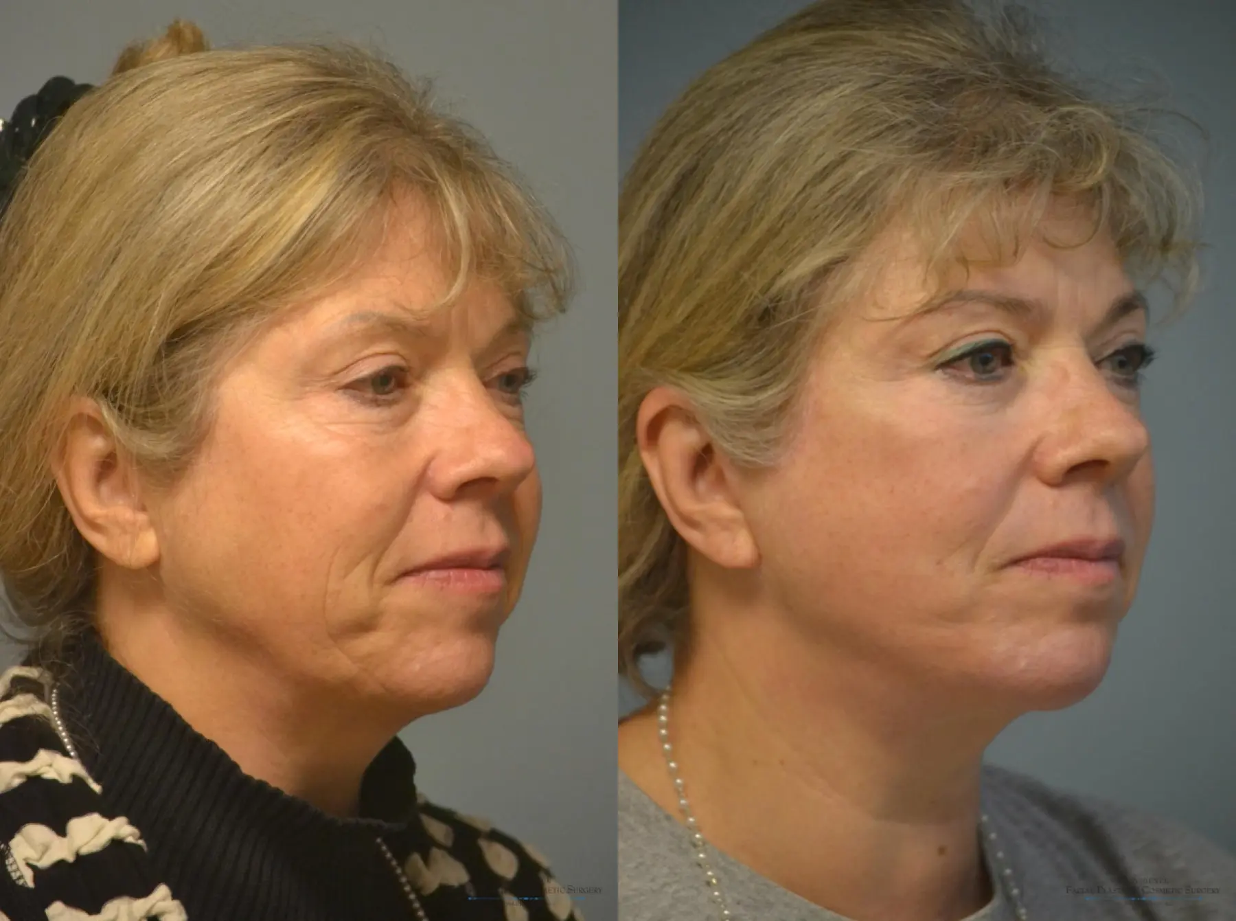 Facelift: Patient 1 - Before and After 4