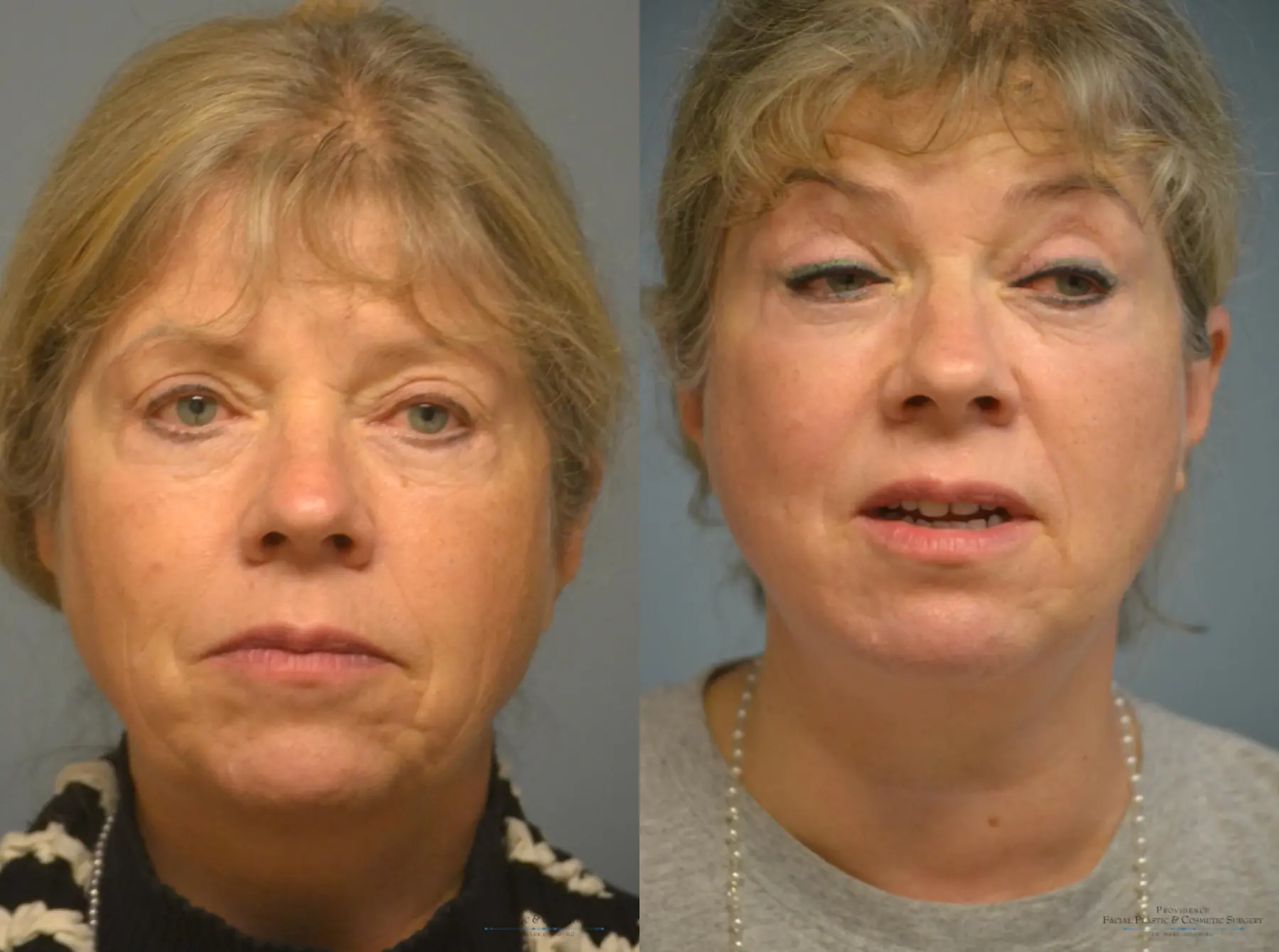 Facelift: Patient 2 - Before and After  
