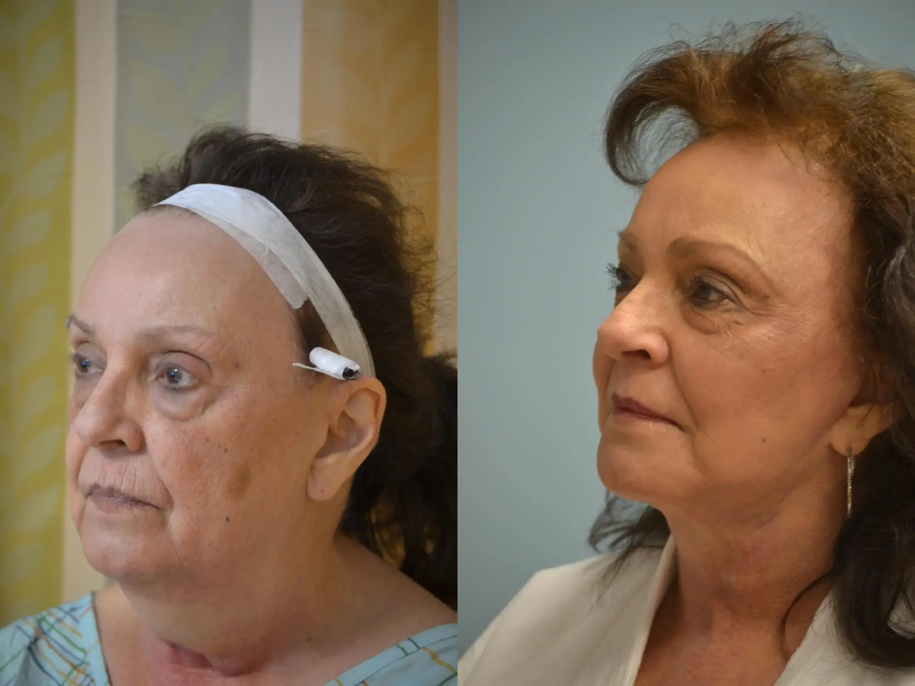 Facelift: Patient 12 - Before and After 3