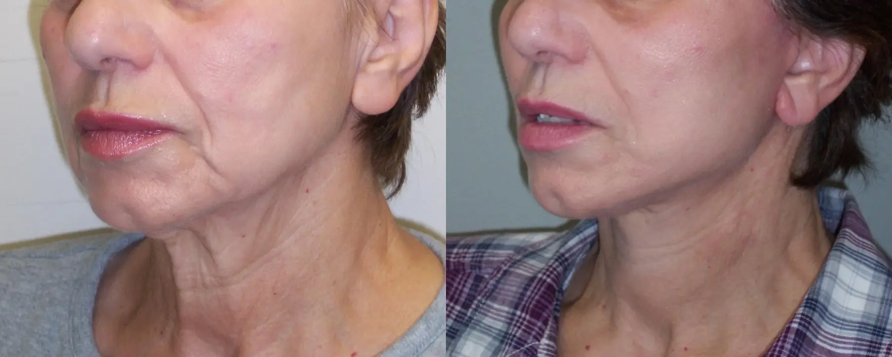 Facelift: Patient 10 - Before and After  