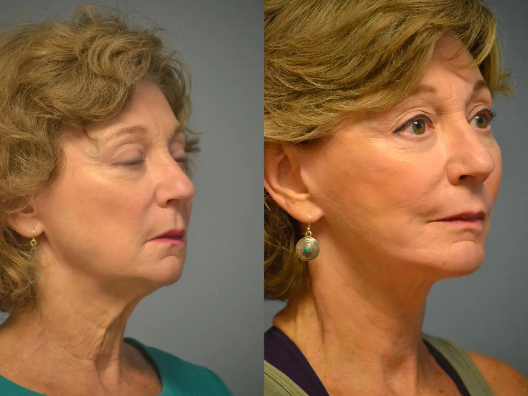 Facelift: Patient 12 - Before and After 4