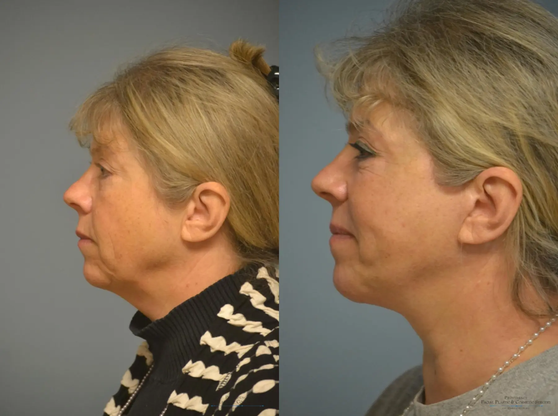 Facelift: Patient 1 - Before and After 2