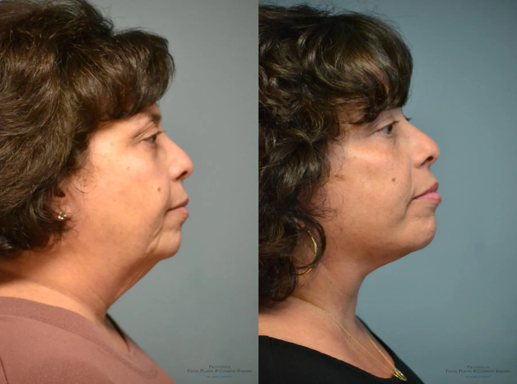 Facelift: Patient 1 - Before and After 2
