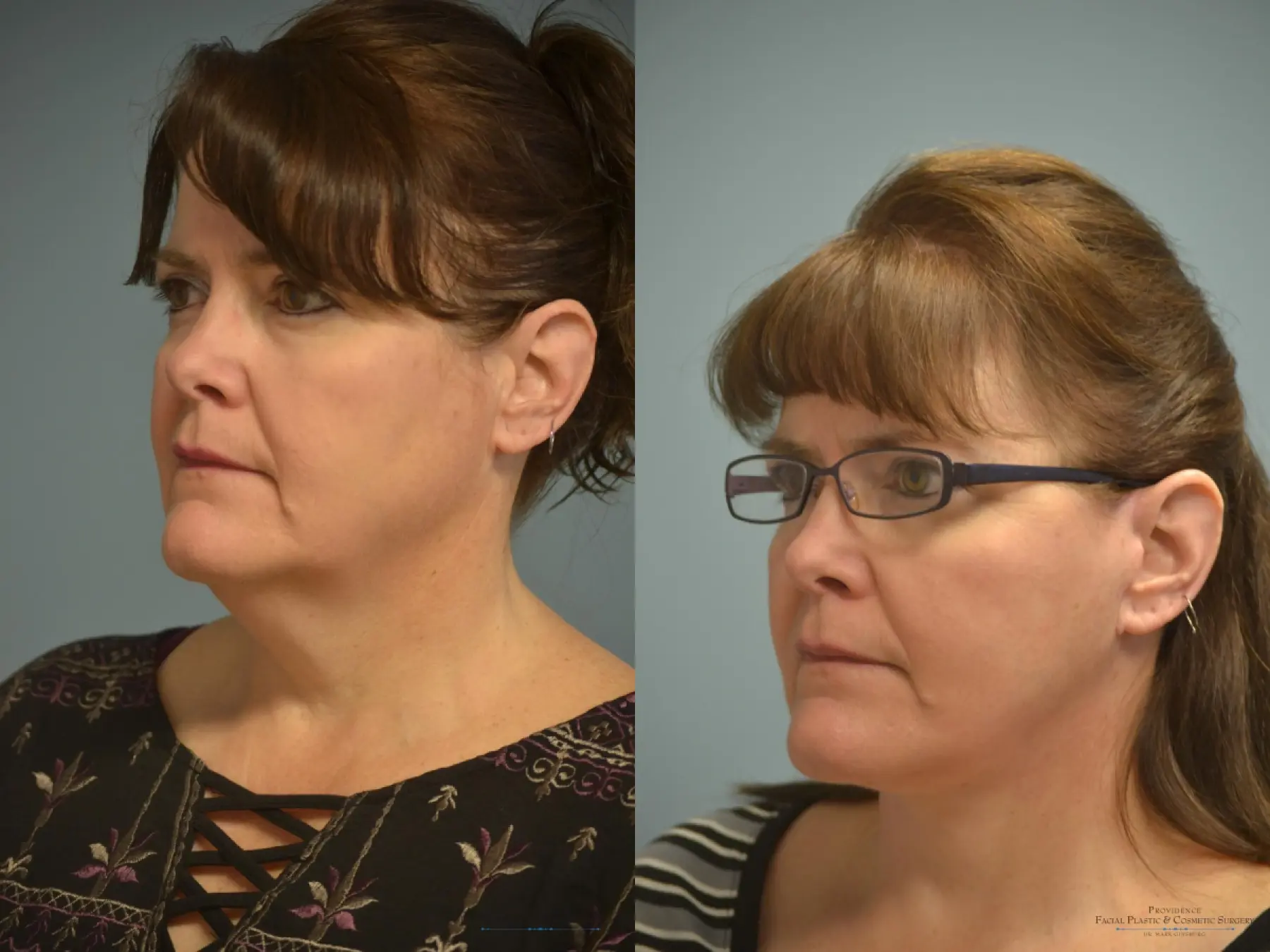 Facelift: Patient 8 - Before and After 2