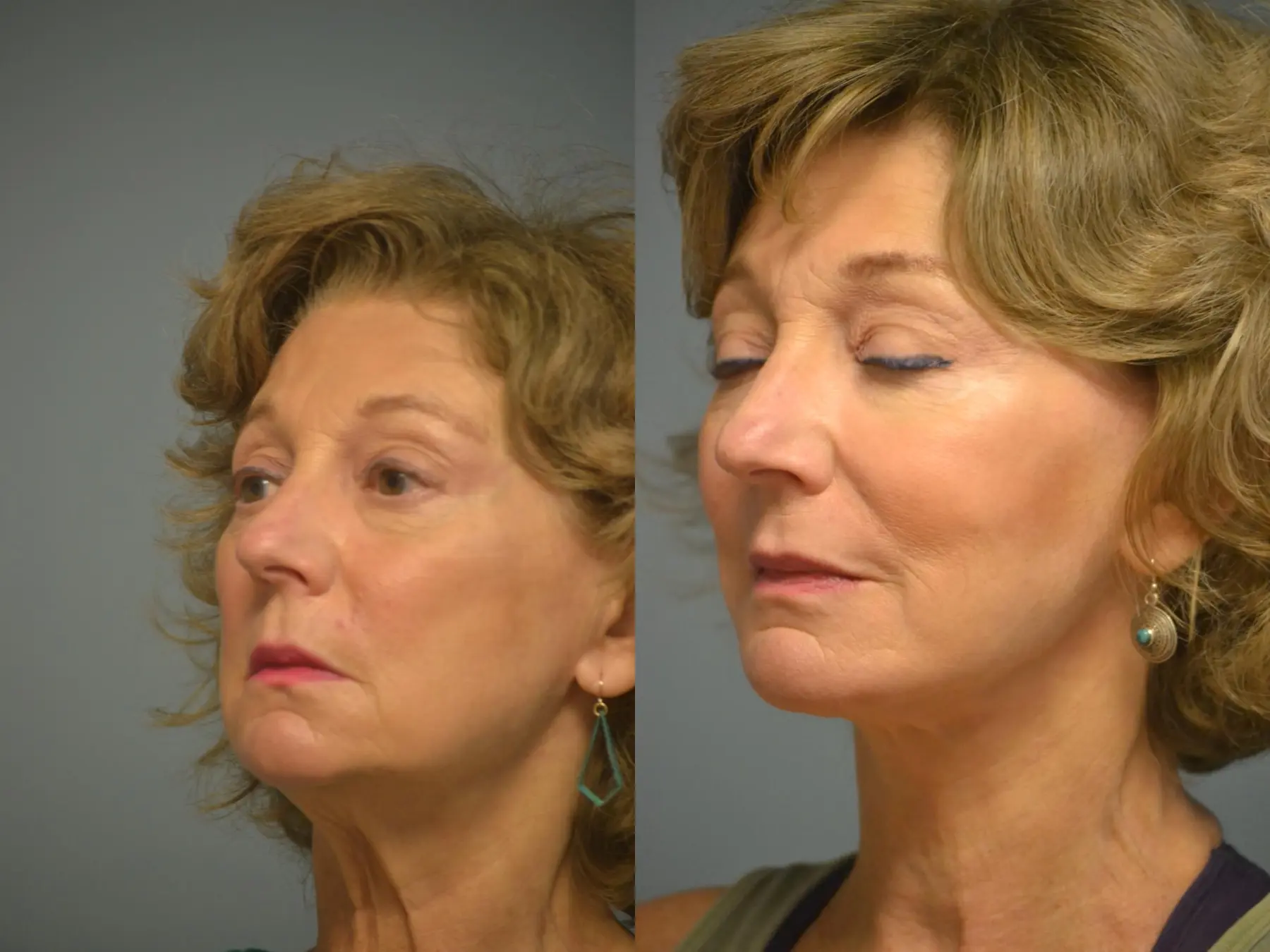 Facelift: Patient 12 - Before and After 2