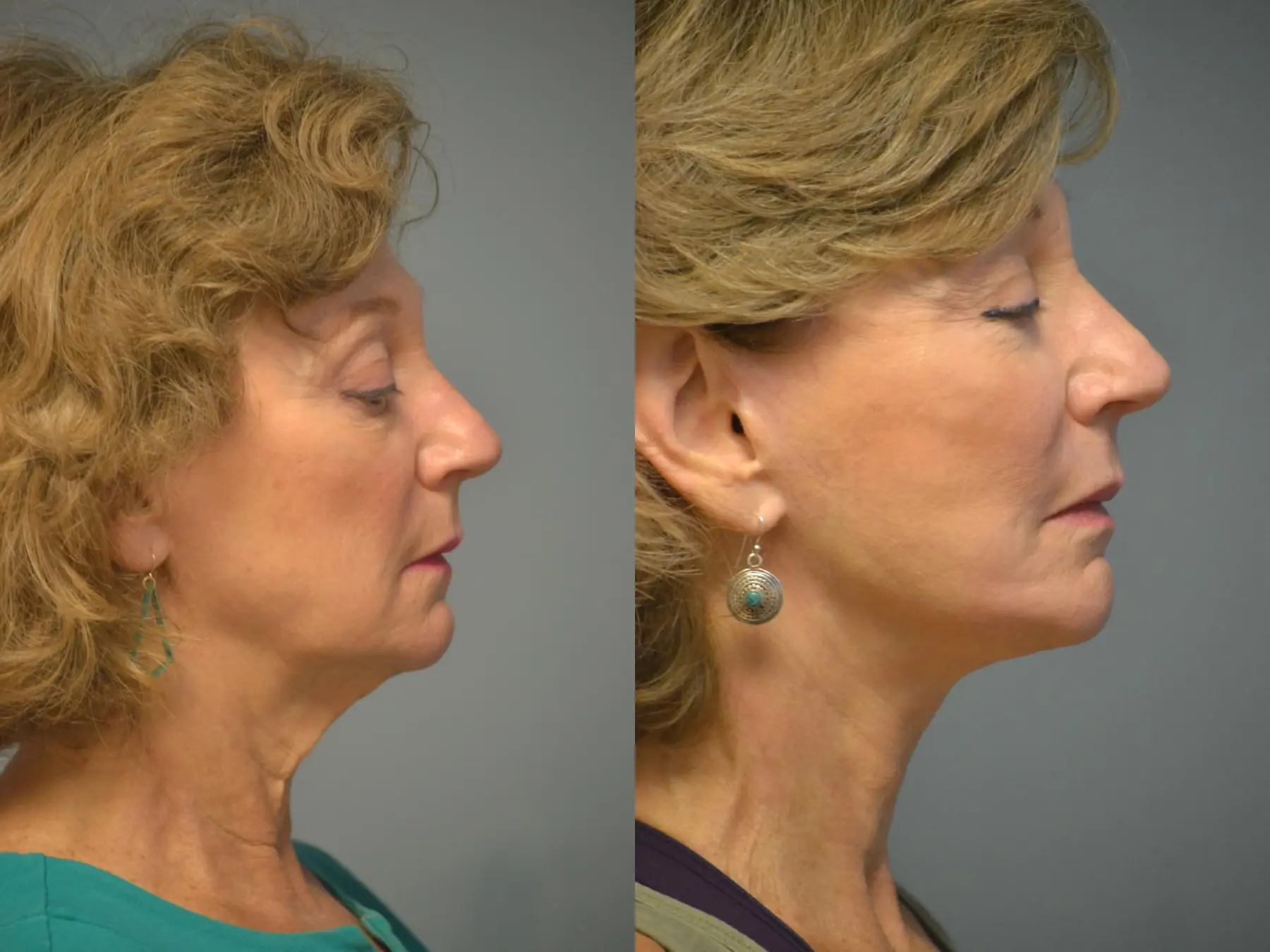 Facelift: Patient 11 - Before and After 5