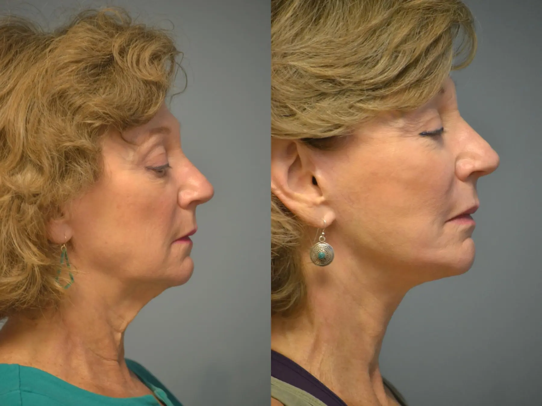 Facelift: Patient 12 - Before and After 5