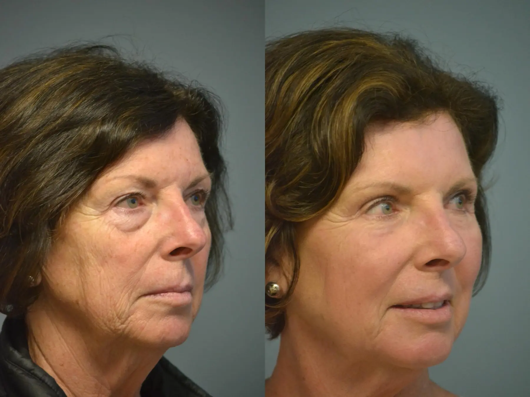 Fat Transfer - Face: Patient 5 - Before and After 3