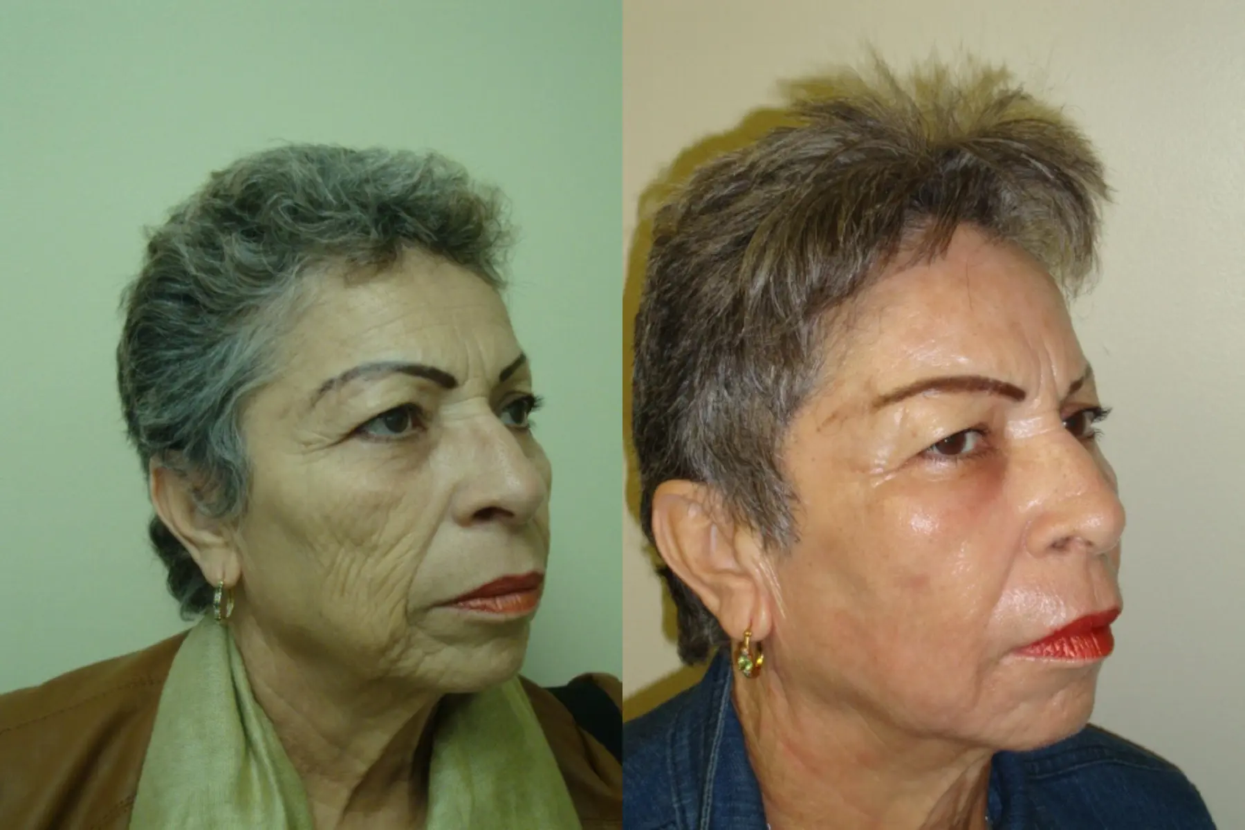 Fat Transfer - Face: Patient 2 - Before and After  
