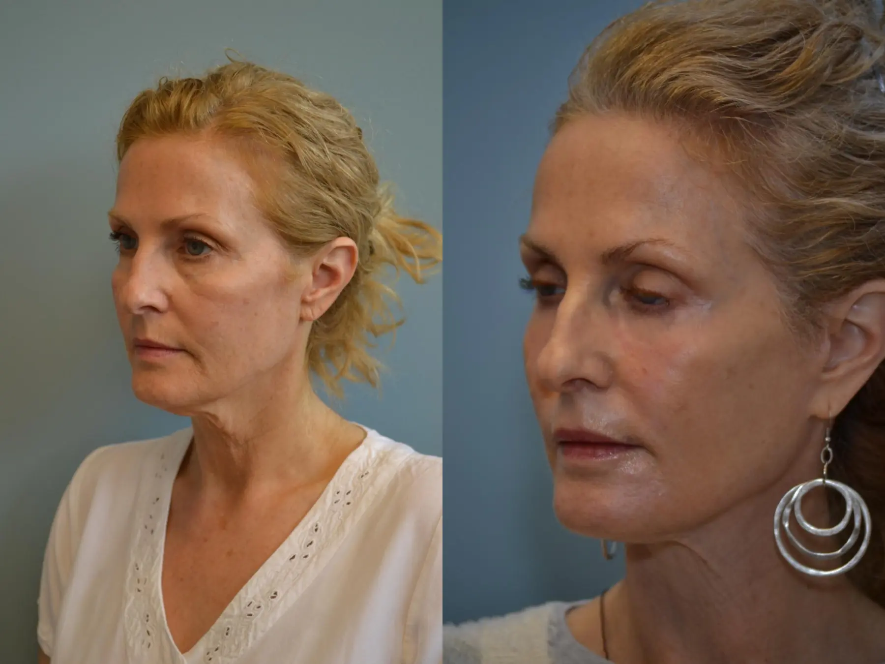 Fat Transfer - Face: Patient 3 - Before and After 2