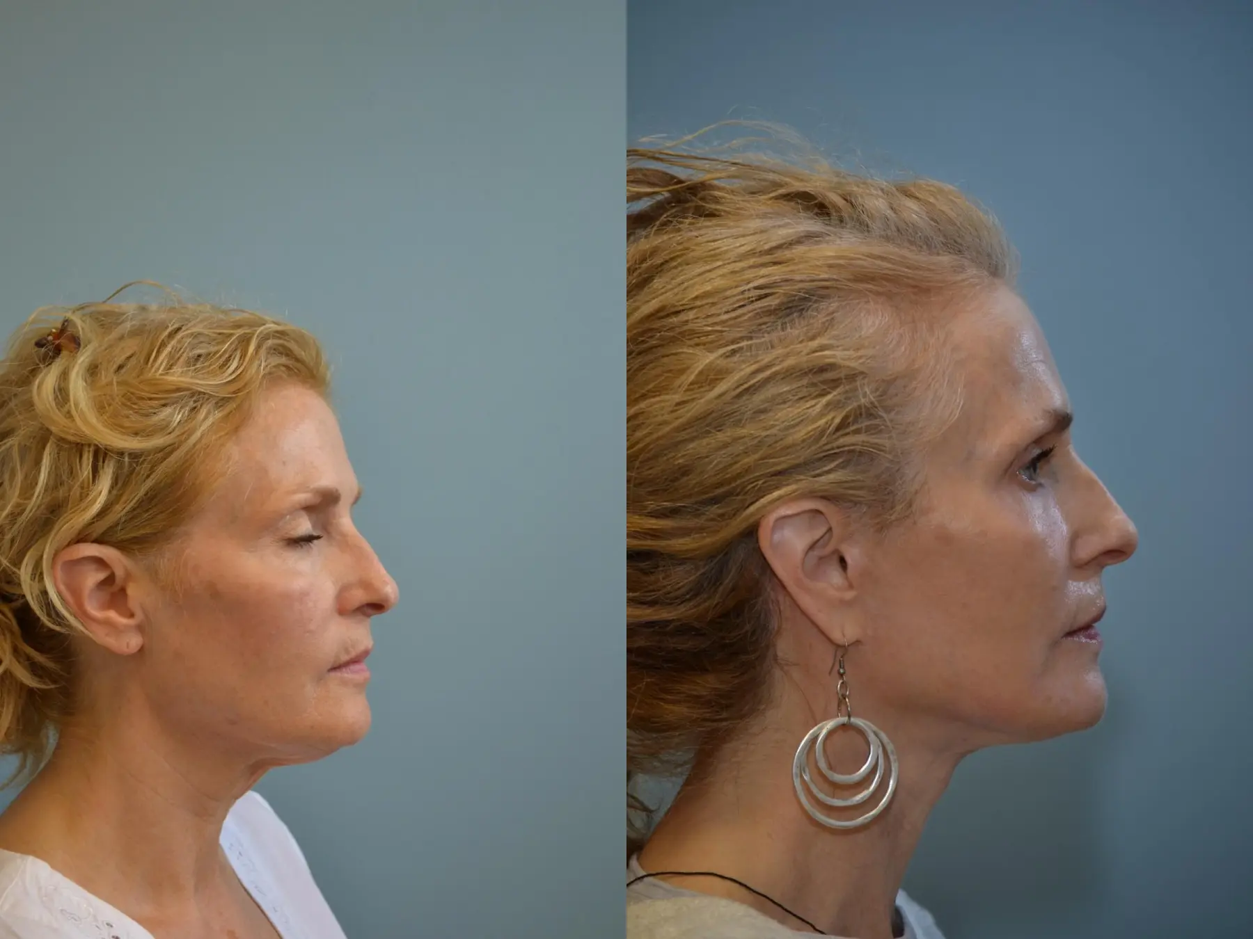 Fat Transfer - Face: Patient 3 - Before and After 3