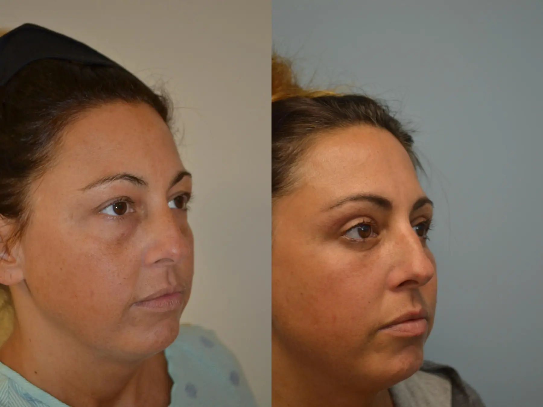 Fat Transfer - Face: Patient 4 - Before and After 2