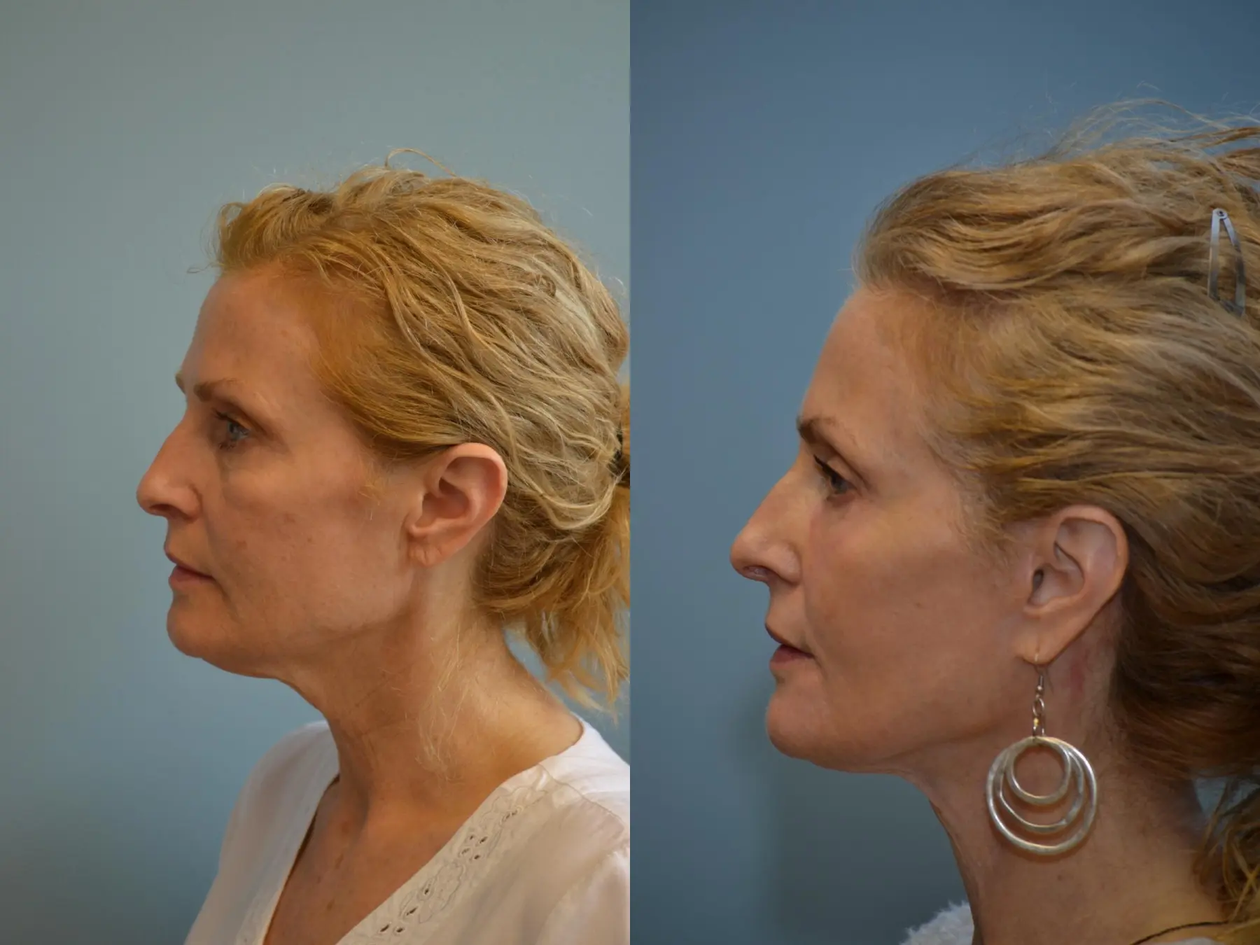 Fat Transfer - Face: Patient 3 - Before and After 5