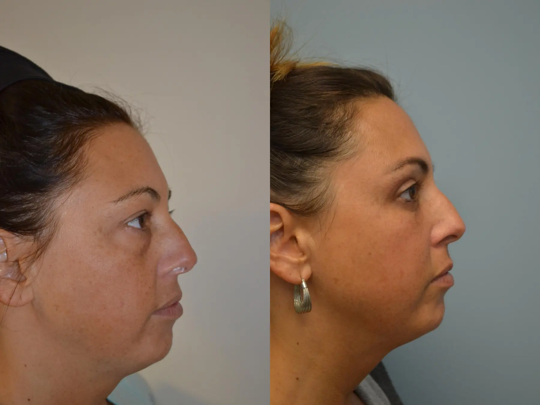 Fat Transfer - Face: Patient 4 - Before and After 3