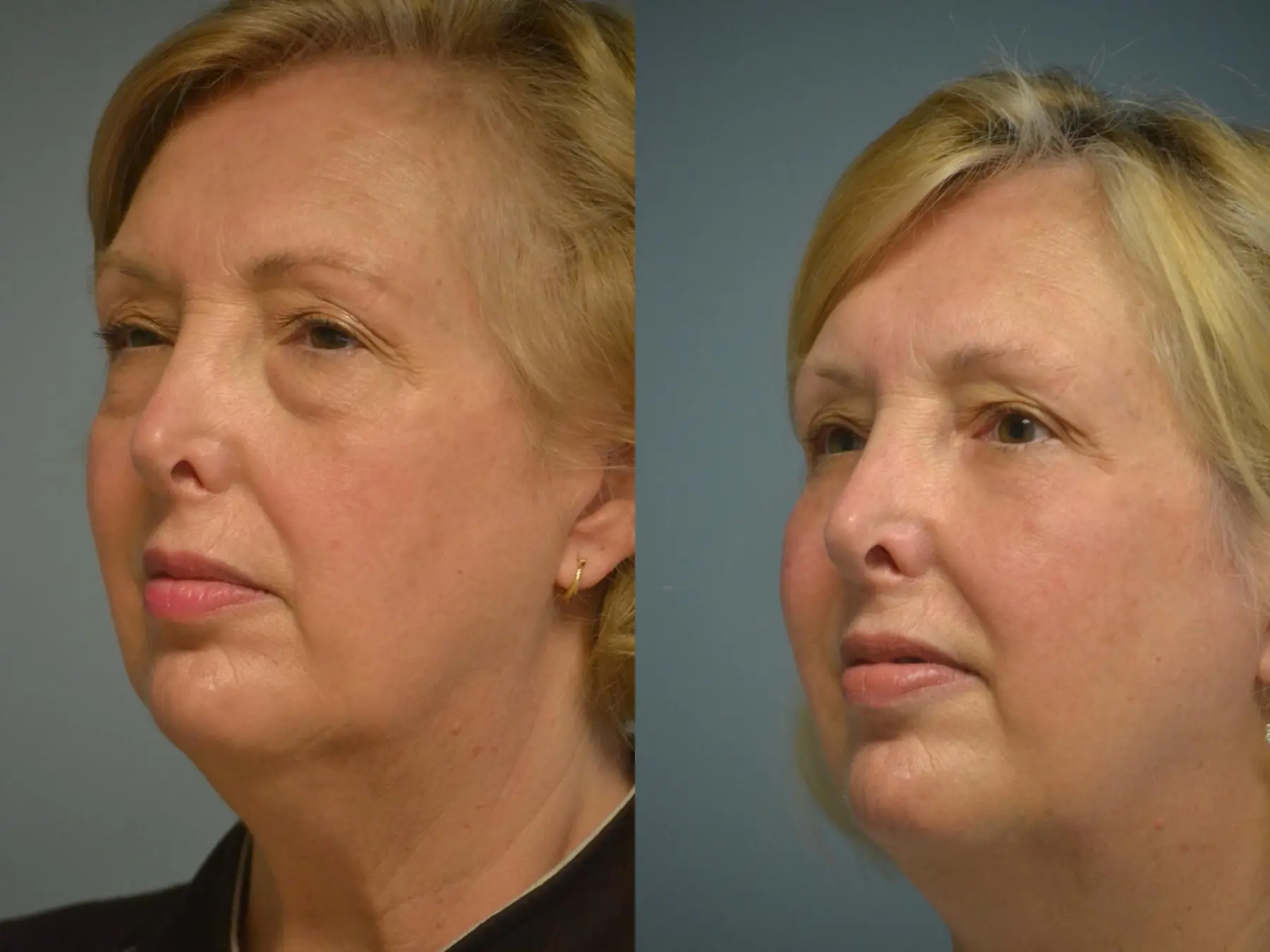 Fat Transfer - Face: Patient 1 - Before and After 2