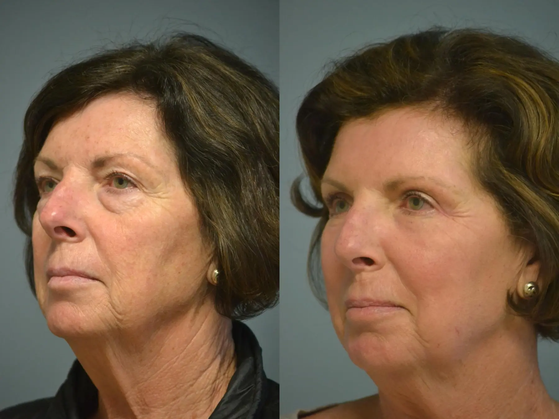 Fat Transfer - Face: Patient 5 - Before and After 2