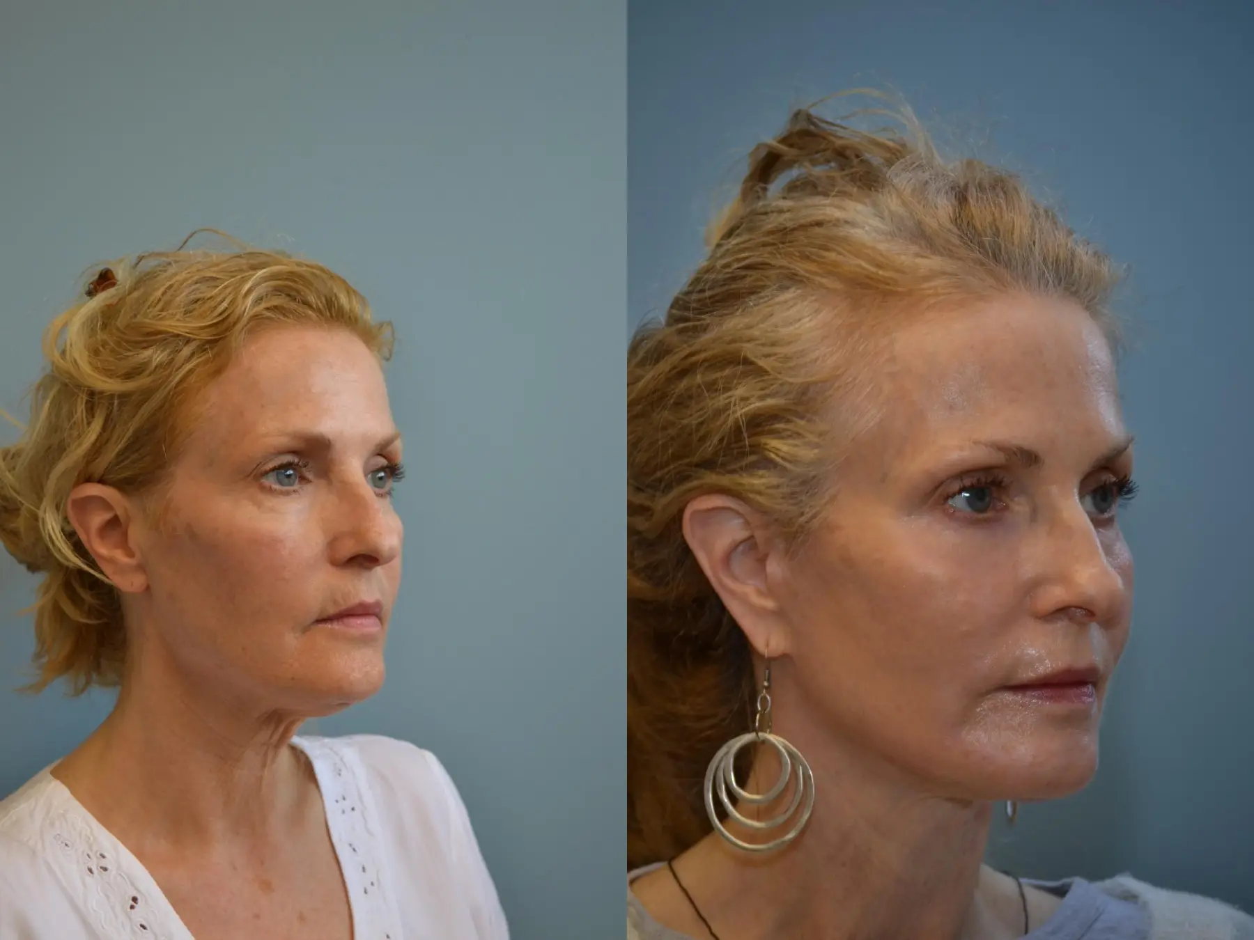 Fat Transfer - Face: Patient 3 - Before and After 4