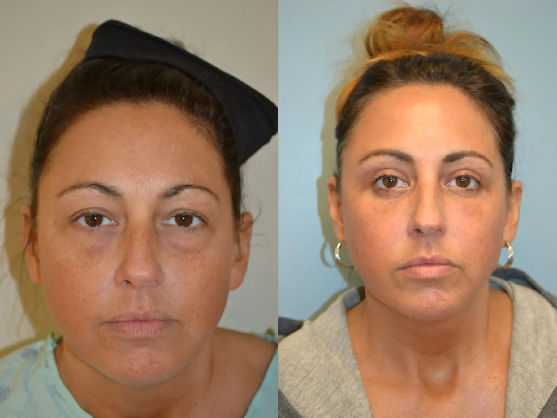 Fat Transfer - Face: Patient 4 - Before and After  