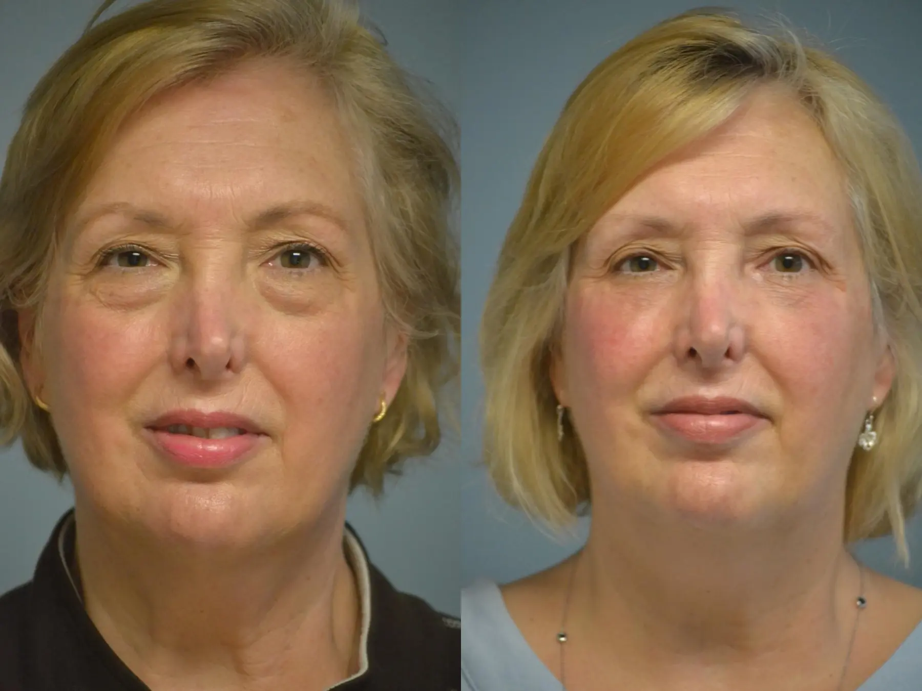 Fat Transfer - Face: Patient 1 - Before and After  