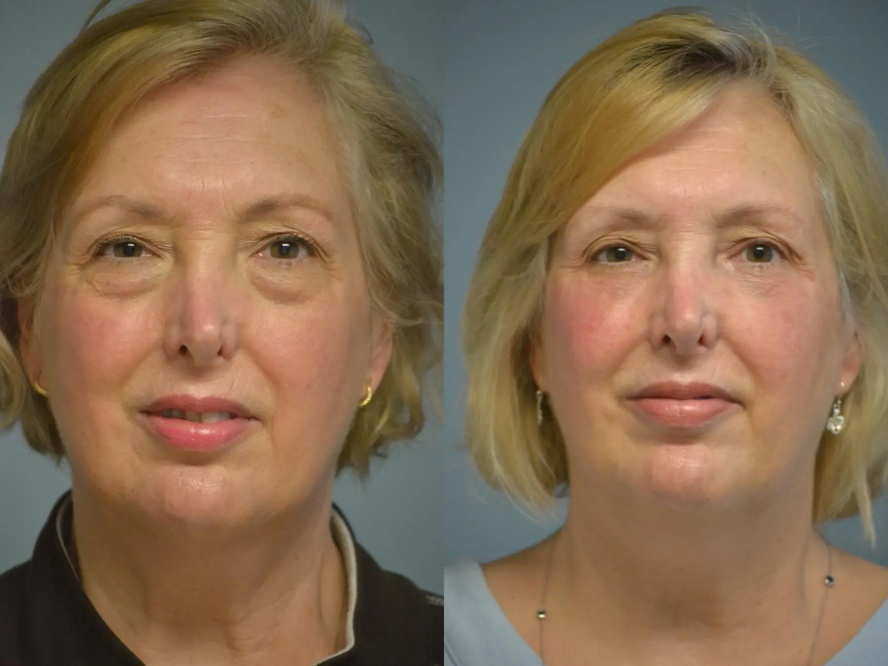 Fat Transfer - Face: Patient 1 - Before and After 1