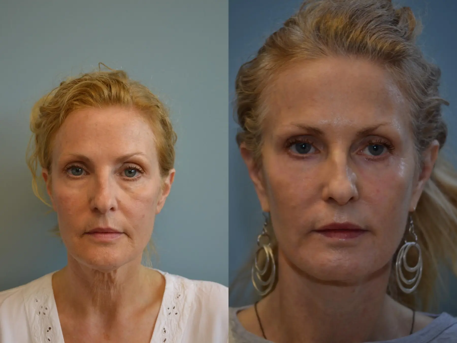 Fat Transfer - Face: Patient 3 - Before and After  