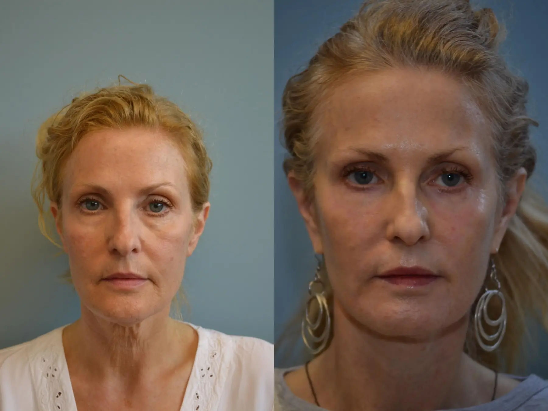 Fat Transfer - Face: Patient 3 - Before and After 1