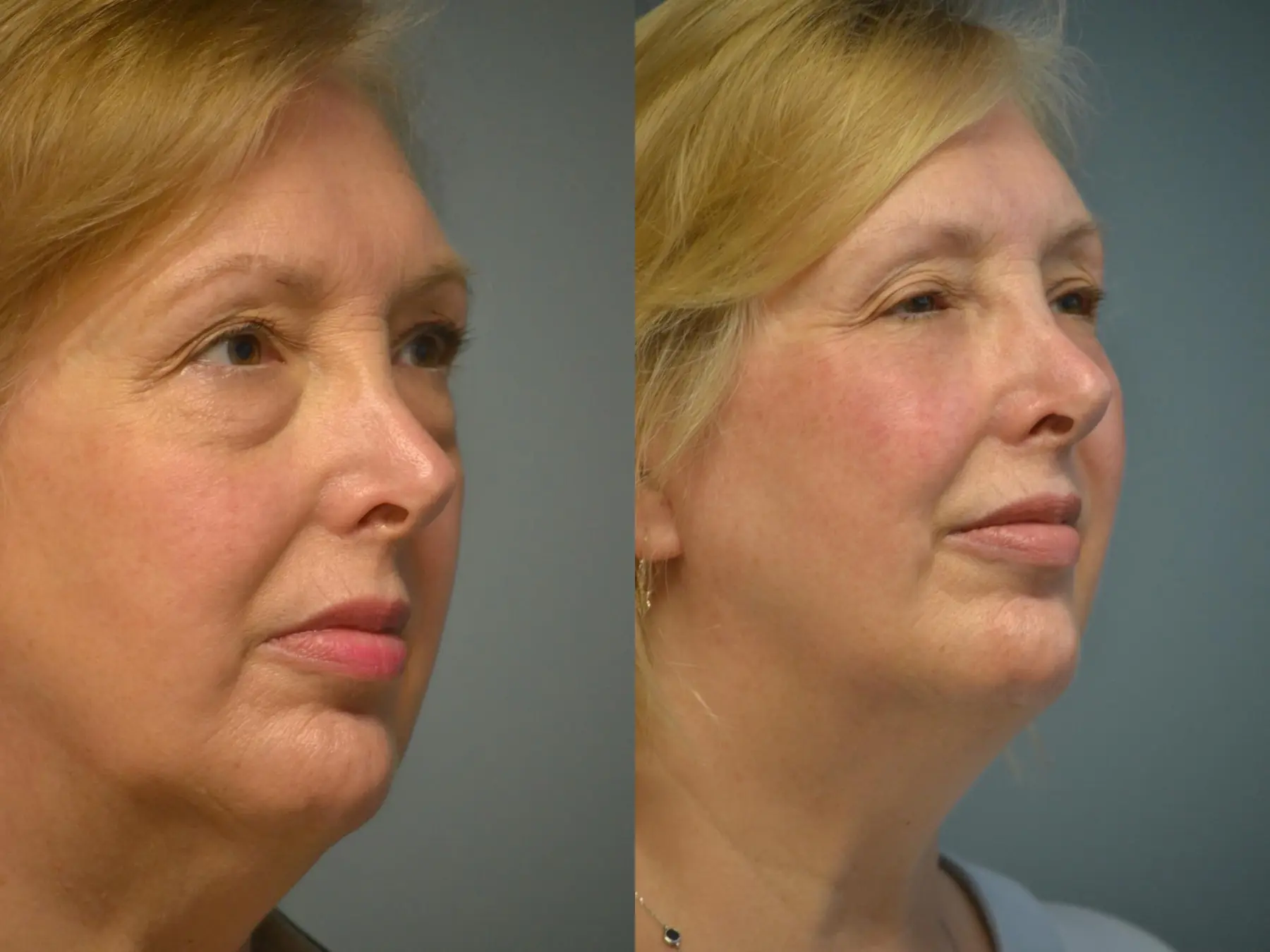 Fat Transfer - Face: Patient 1 - Before and After 3
