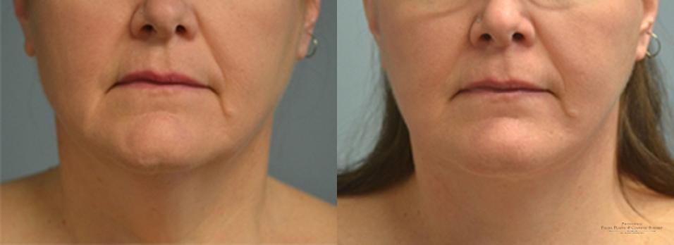 Facelift: Patient 8 - Before and After  
