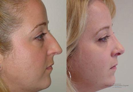 Rhinoplasty: Patient 21 - Before and After 2