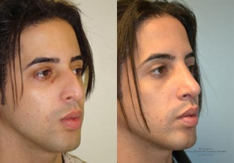 Rhinoplasty: Patient 19 - Before and After 3