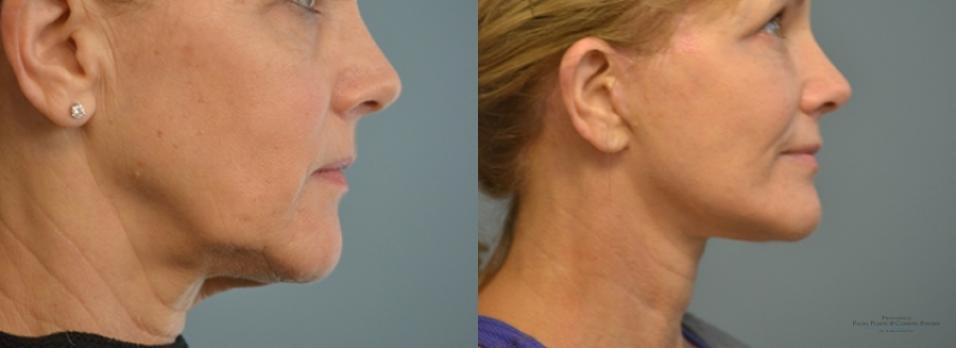 Facelift: Patient 10 - Before and After 3