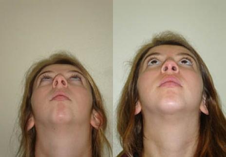 Rhinoplasty: Patient 31 - Before and After 4
