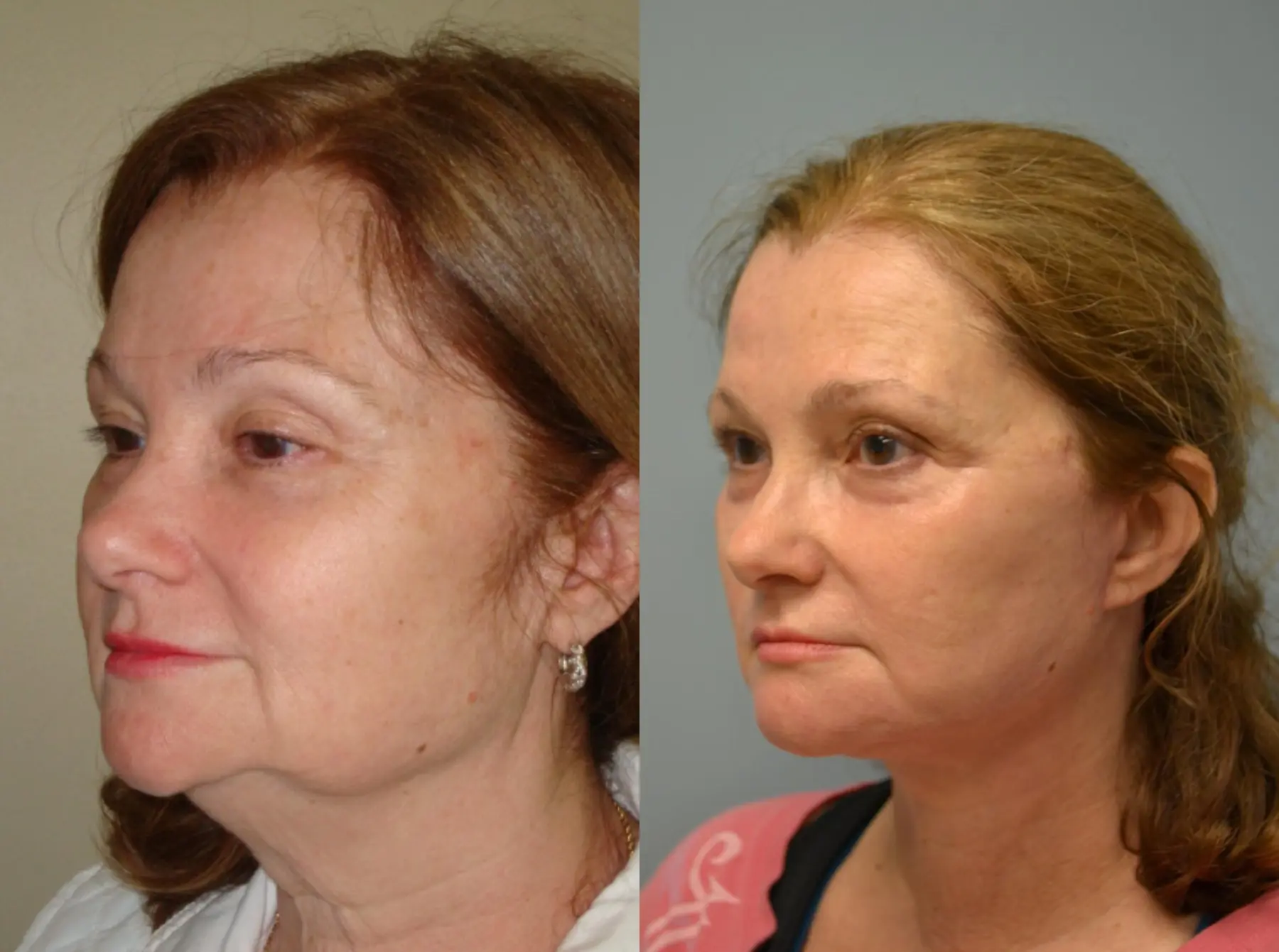 Laser Skin Resurfacing - Face: Patient 4 - Before and After 2