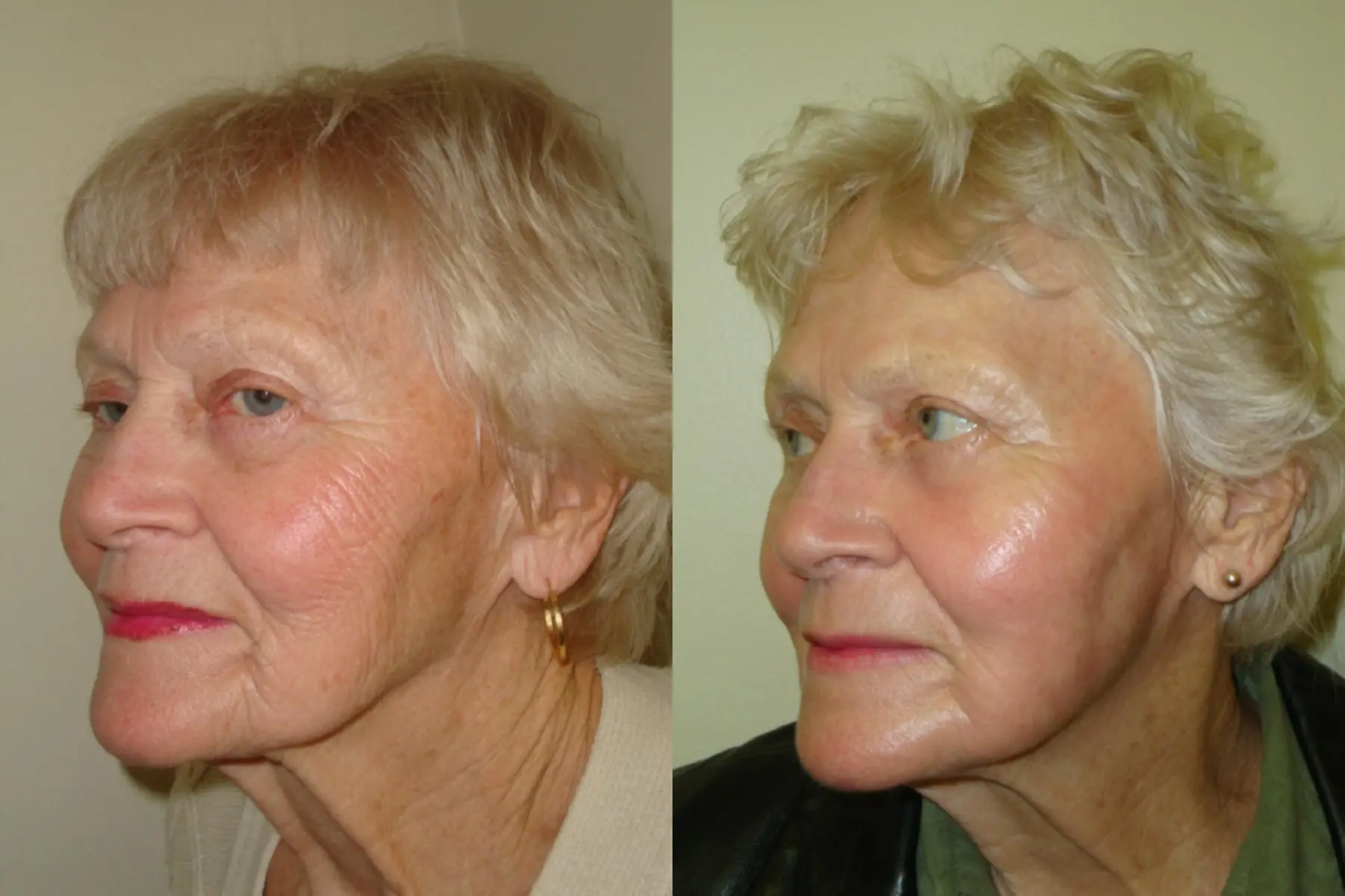 Laser Skin Resurfacing - Face: Patient 1 - Before and After  