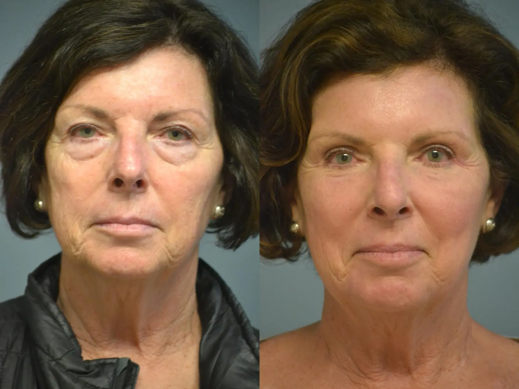 Laser Skin Resurfacing - Face: Patient 5 - Before and After 1