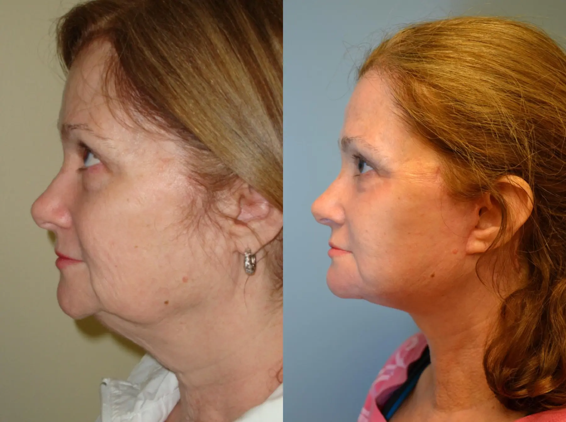 Laser Skin Resurfacing - Face: Patient 4 - Before and After  