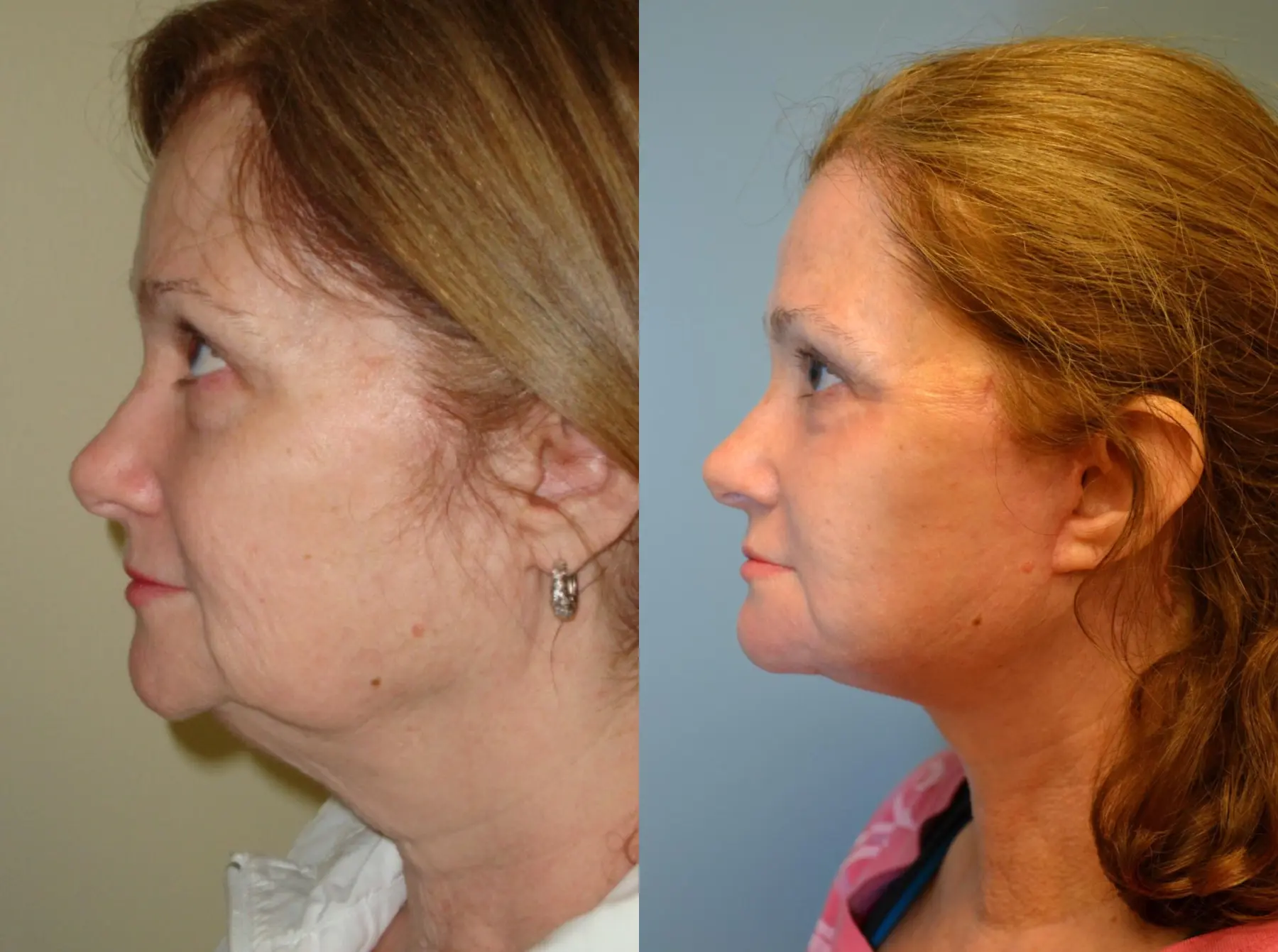 Laser Skin Resurfacing - Face: Patient 4 - Before and After 1