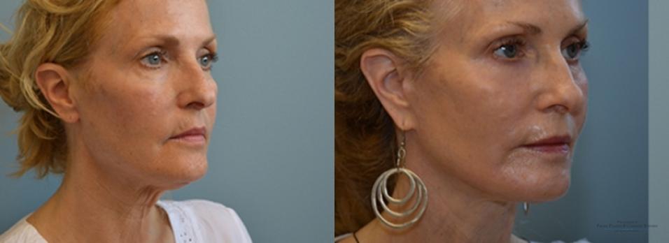 Facelift: Patient 7 - Before and After 3