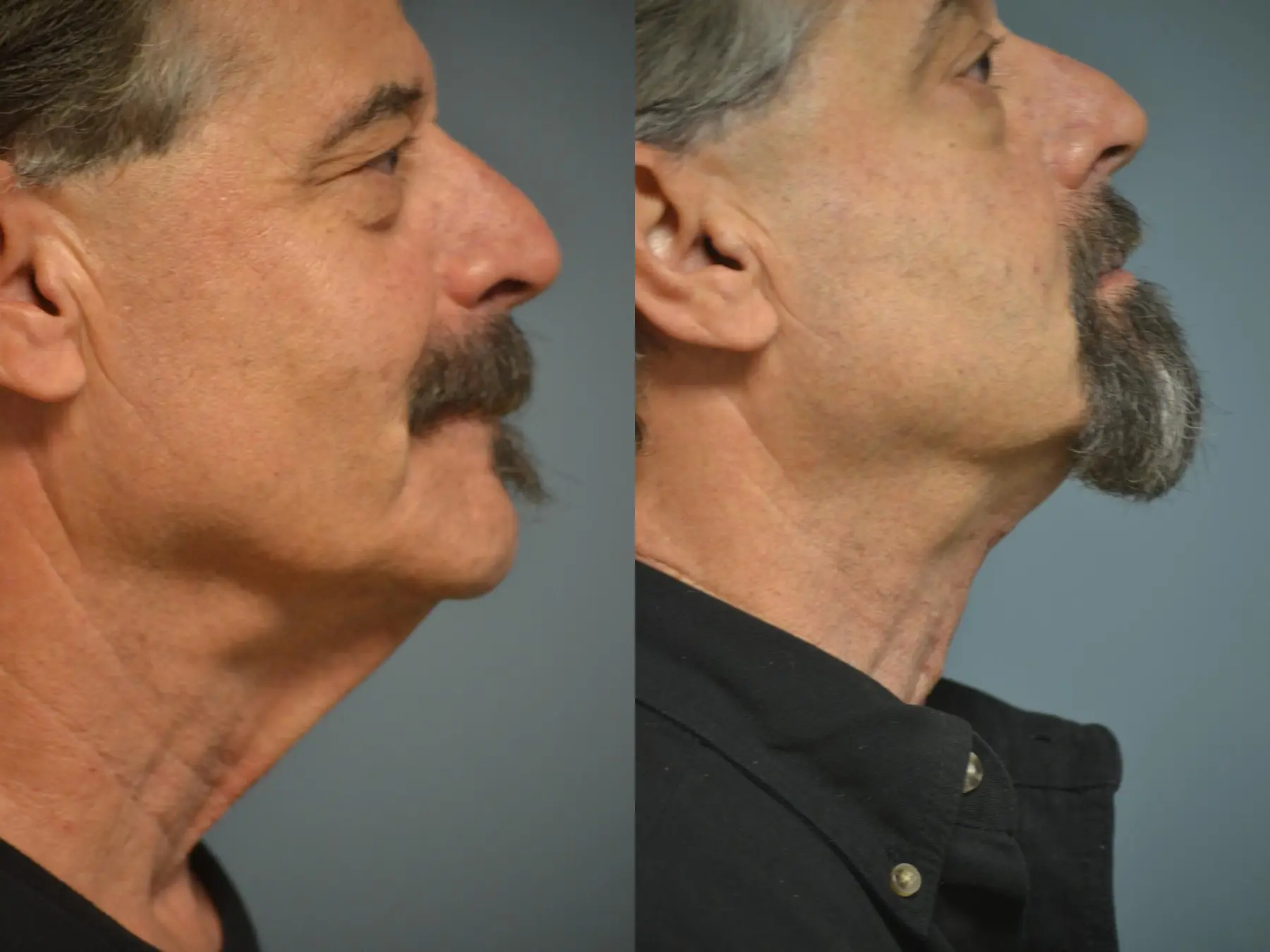 Neck Lift: Patient 1 - Before and After 2