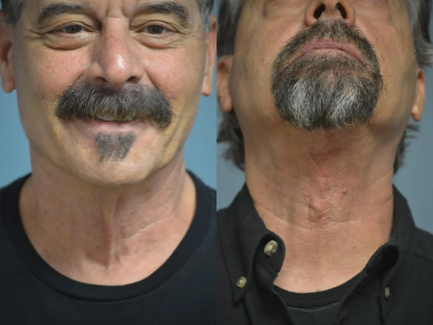 Neck Lift: Patient 1 - Before and After  