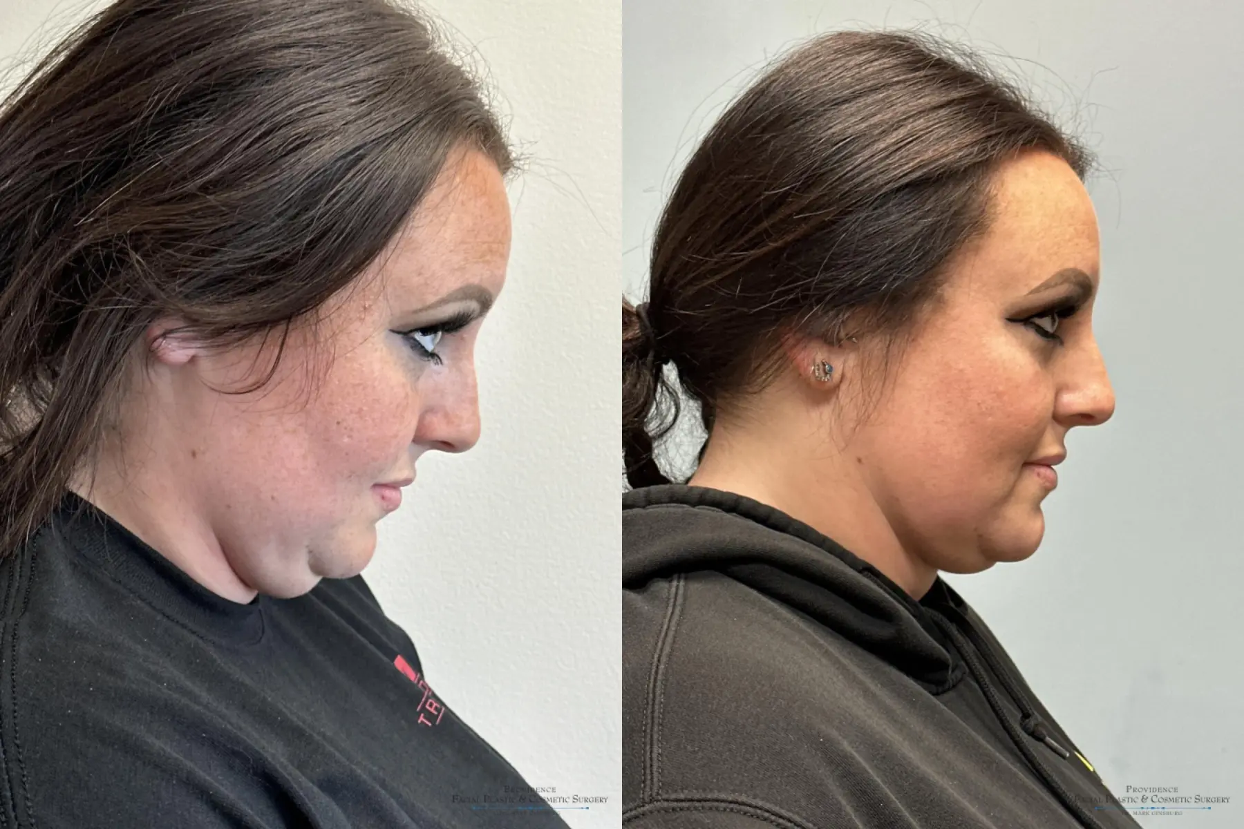 Neck Lift: Patient 1 - Before and After 2