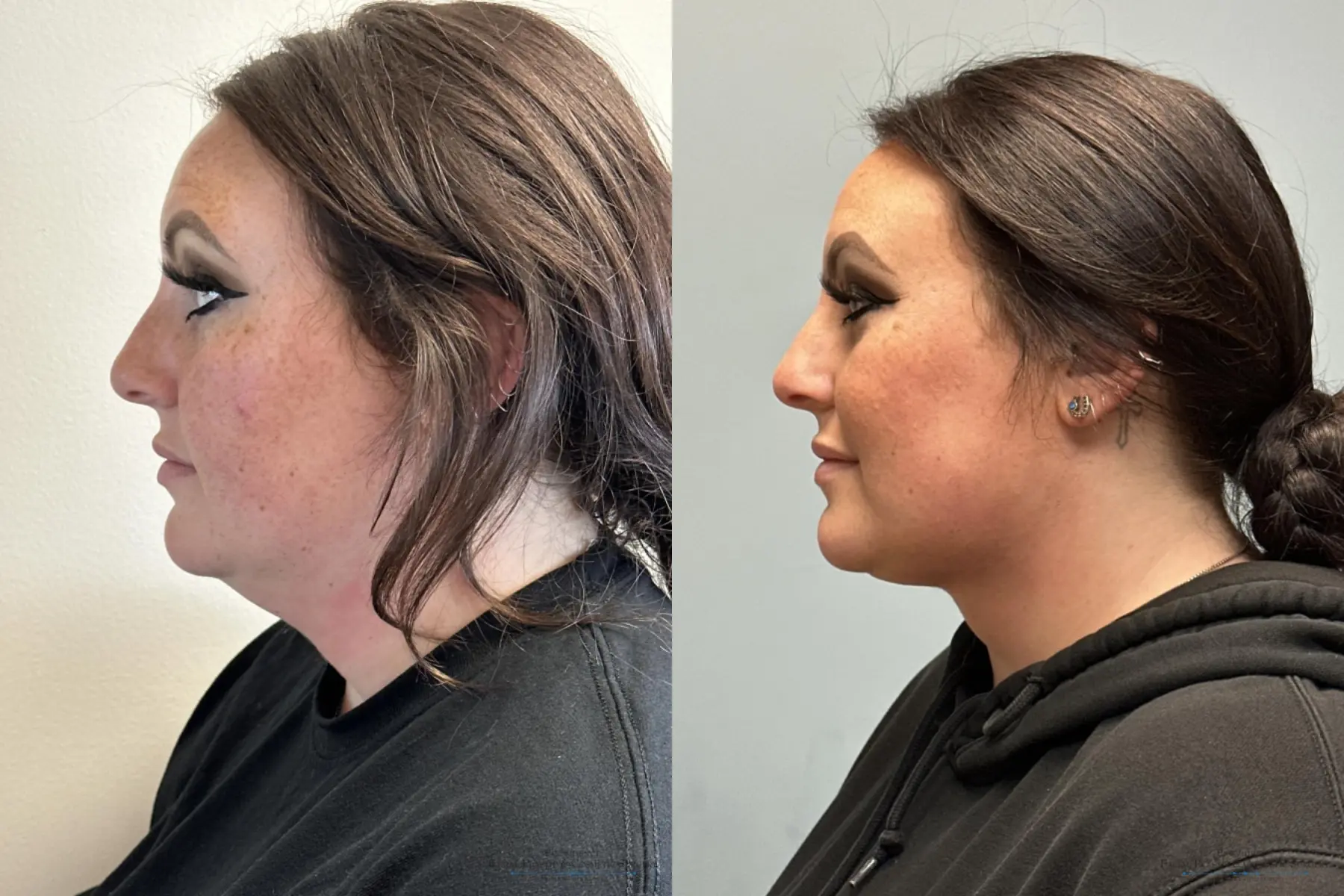 Neck Lift: Patient 1 - Before and After  