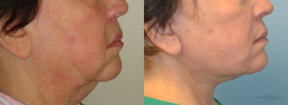 Facelift: Patient 4 - Before and After 3